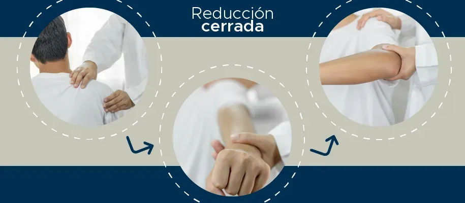 Diagrama que muestra la anatomía del codo y el procedimiento de artroscopia