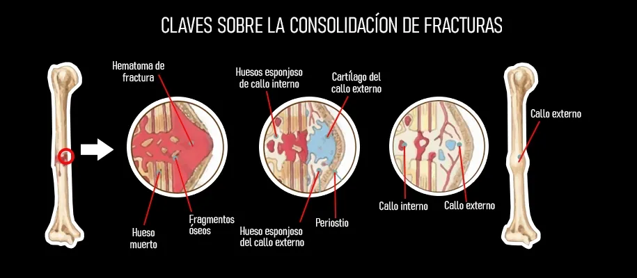 7 Factores que Retrasan la Curación Ósea | Especialista en Traumatología Tijuana Infografía comparativa: Cómo el tabaquismo y diabetes afectan el tiempo de curación de fracturas