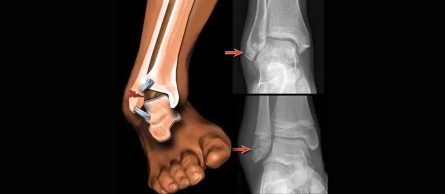 Ankle surgery
