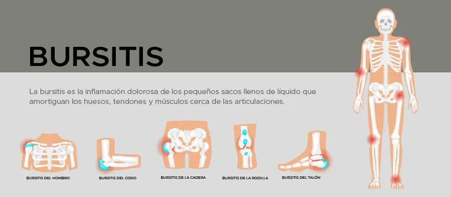 Dr. Monge explica las posibles molestias cuando tienes bursitis Dr. Monge explica las posibles molestias cuando tienes bursitis