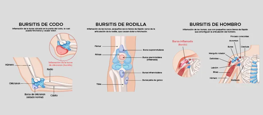 Dr. Monge explica los tipos de bursitis Dr. Monge explica los tipos de bursitis