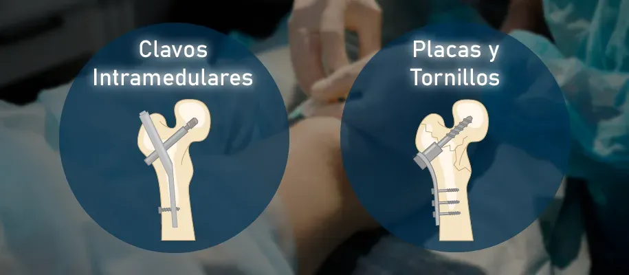 Dr. Monge explica la diferencia entre placa y tornillos Dr. Monge explica la diferencia entre placa y tornillos