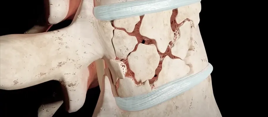 Imagen de fractura de tibia y peroné
