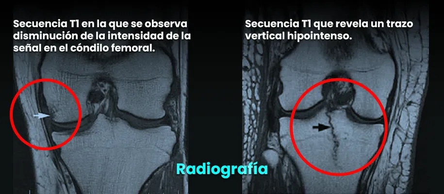 El DR. Ricardo Monge explica de forma sencilla los principales sintomas de la tendinitis que es un proceso agudo inflamatorio El DR. Ricardo Monge explica de forma sencilla los principales sintomas de la tendinitis que es un proceso agudo inflamatorio